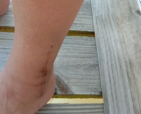 Juanita's leg now